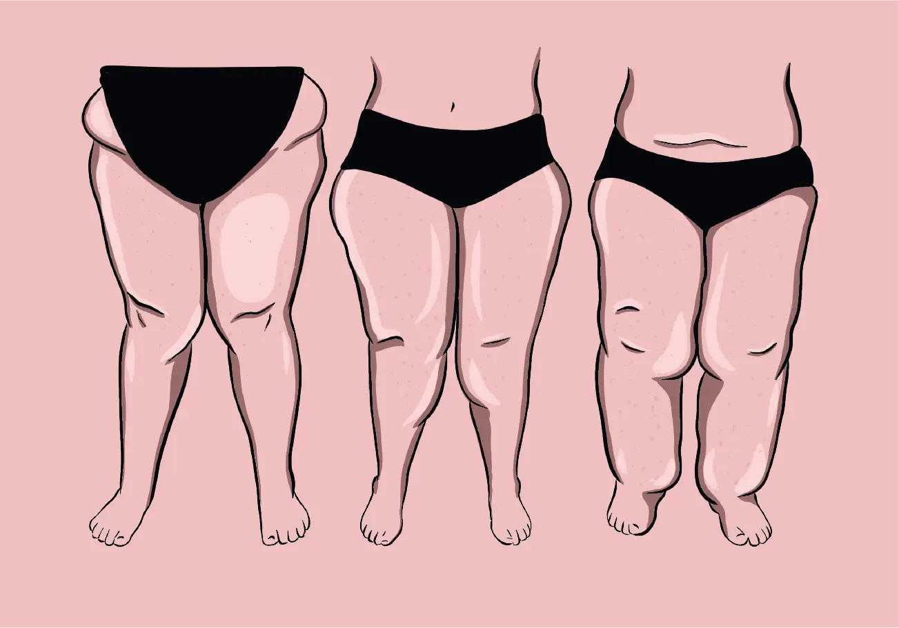 Illustration éducative sur le lipœdème et le parcours de soins